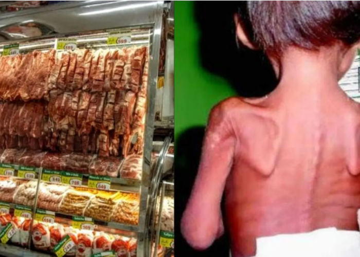 Preço da carne pode levar a explosão de casos de anemia em crianças, aponta reportagem da Revista Fórum